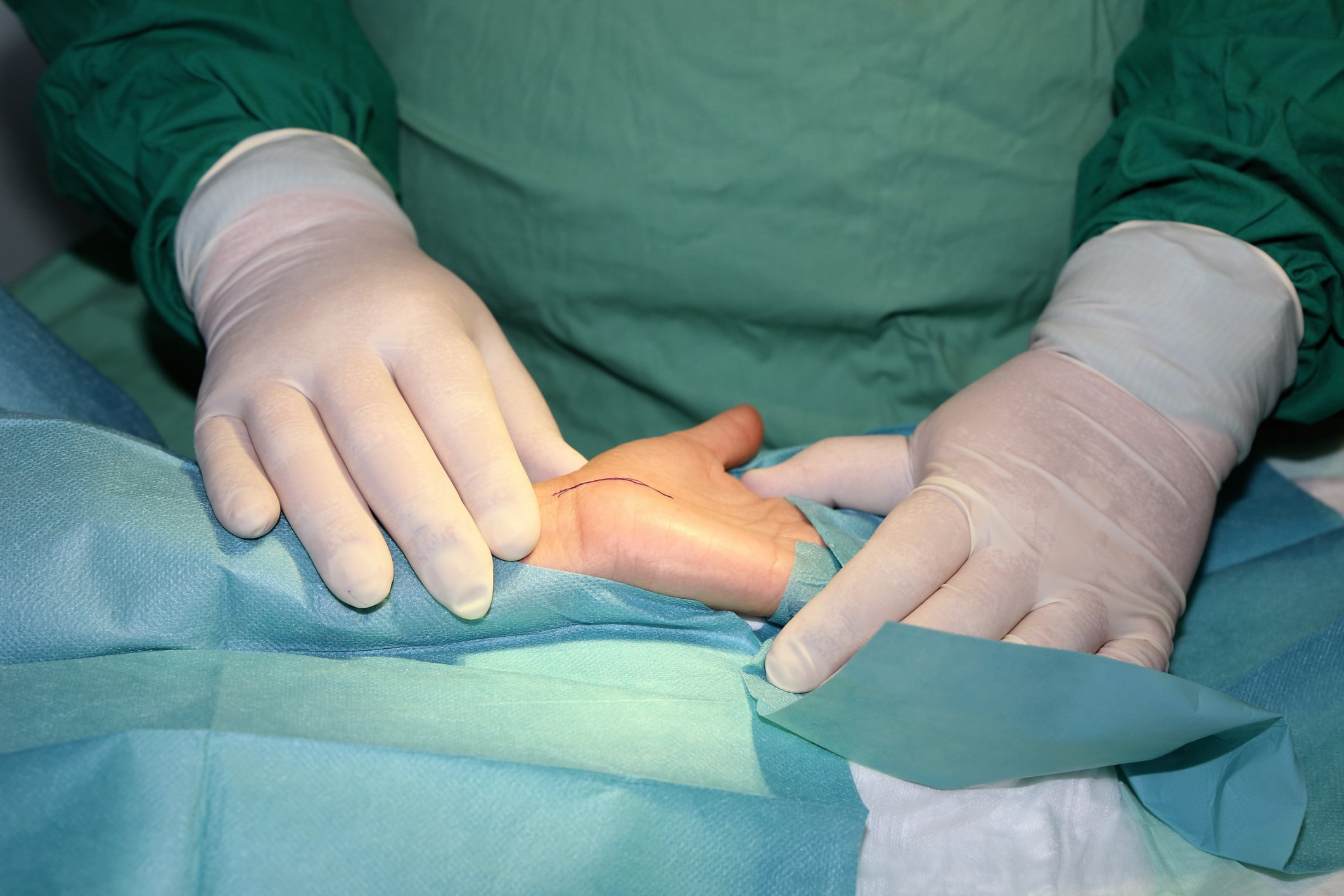 Ein Chirurg mit Handschuhen bereitet die Hand eines Patienten auf einen Eingriff zur Behandlung des Karpaltunnelsyndroms (KTS) vor. Dabei wird ein sichtbarer Einschnitt in die Handfläche gemacht und chirurgische Tücher angebracht.