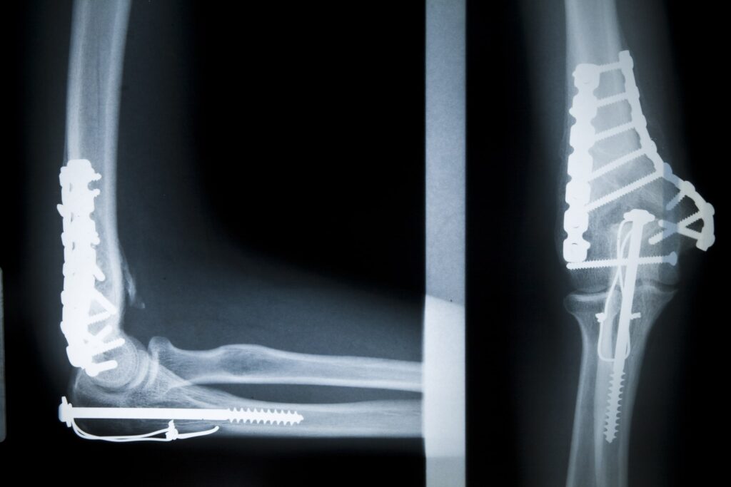 Röntgenbilder zeigen eine Ellenbogengelenksfraktur, bei der Metallplatten und Schrauben zur Stabilisierung des gebrochenen Arms chirurgisch implantiert wurden.