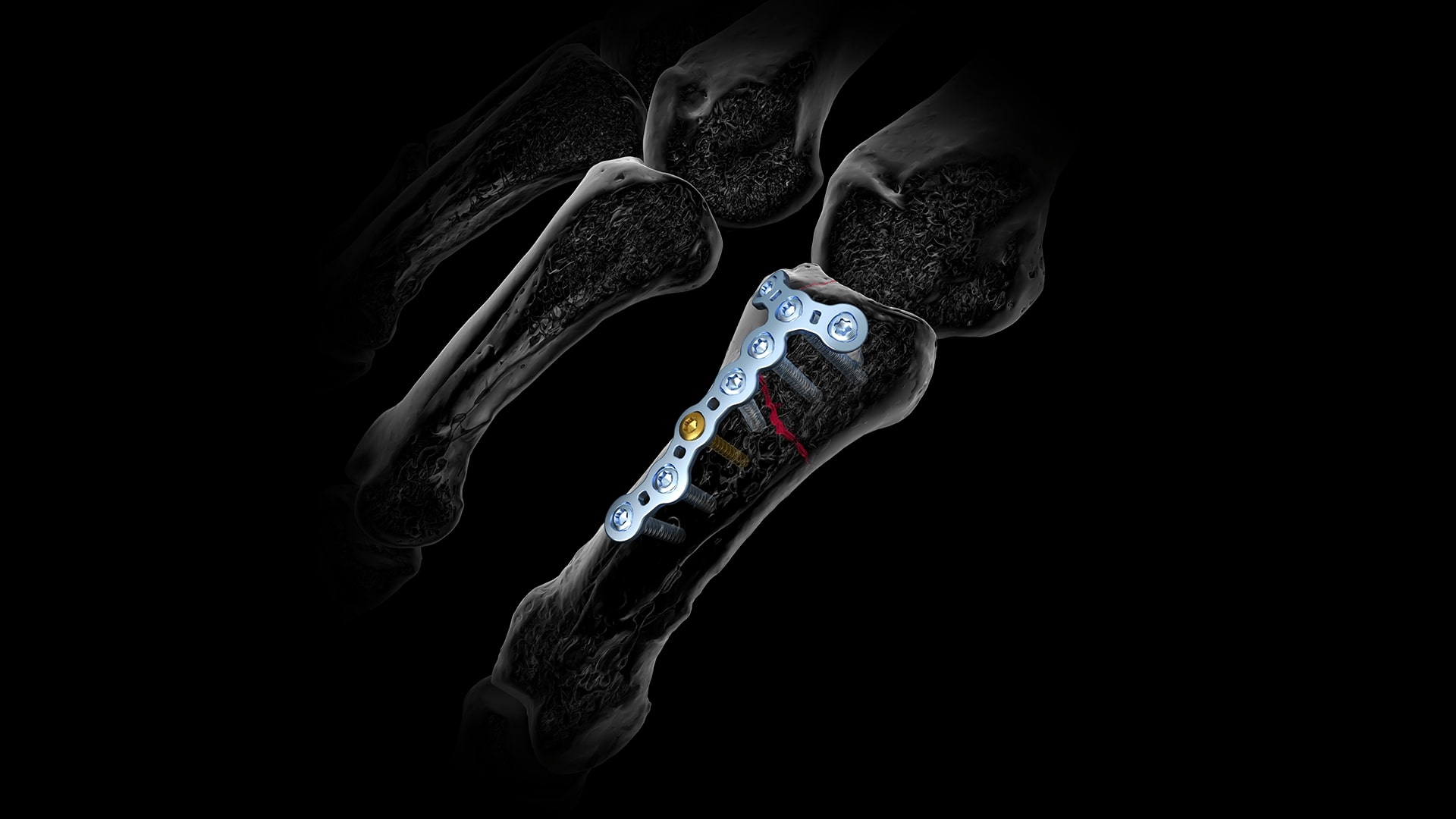 Röntgenbild eines Fußes mit einer orthopädischen Metallplatte und Schrauben, die an einem Mittelfußknochen befestigt sind, ähnlich wie bei der Behandlung von Fingerfrakturen, was auf eine chirurgische Fixierung hinweist.