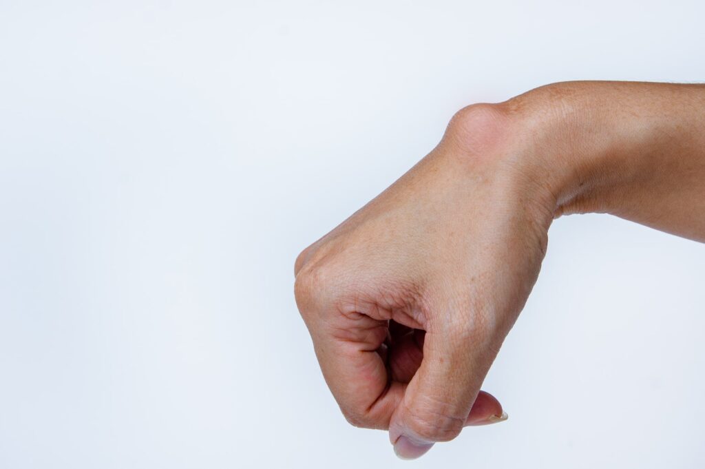 Eine menschliche Hand mit einem sichtbaren Ganglion (Überbein), das einen Knoten oder eine Schwellung in der Nähe des Handgelenks verursacht, vor einem schlichten weißen Hintergrund.
