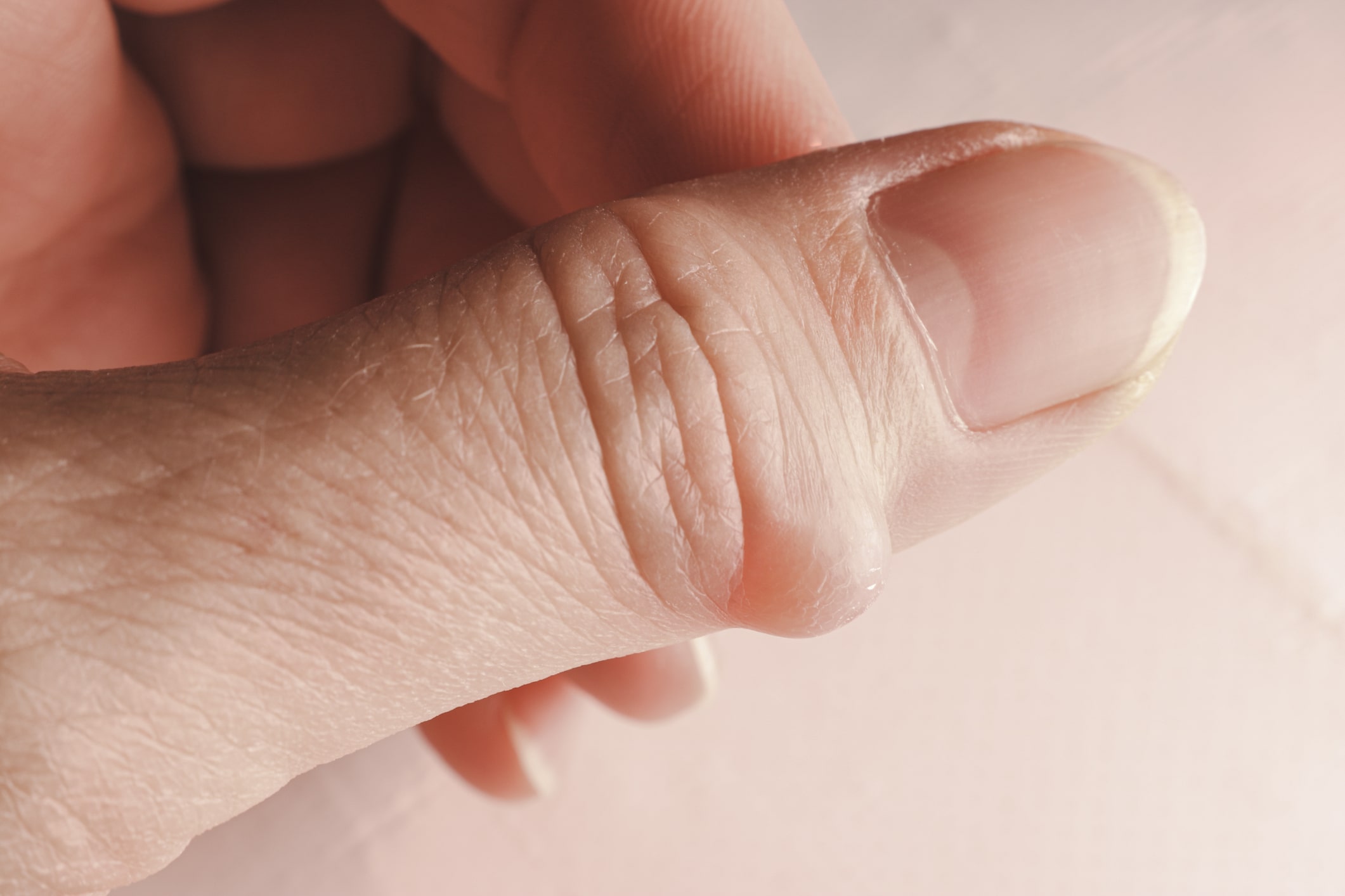 Nahaufnahme eines Daumens mit einer kleinen Beule oder Blase in der Nähe des Knöchels, möglicherweise eine Mukoidzyste, mit detaillierter Hauttextur und Fingernagelmerkmalen.