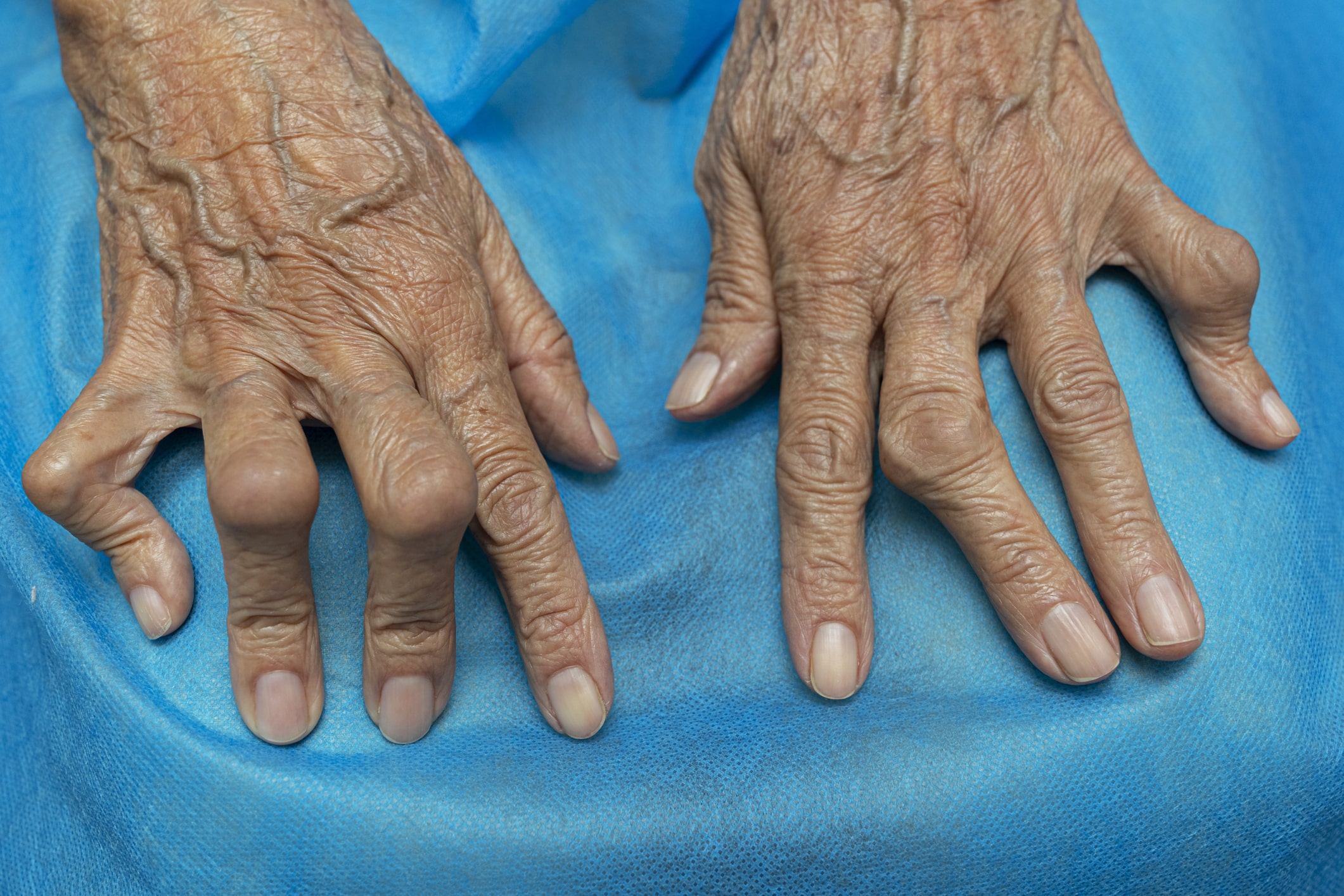 Foto von Fingern mit rheumatoider Arthritis