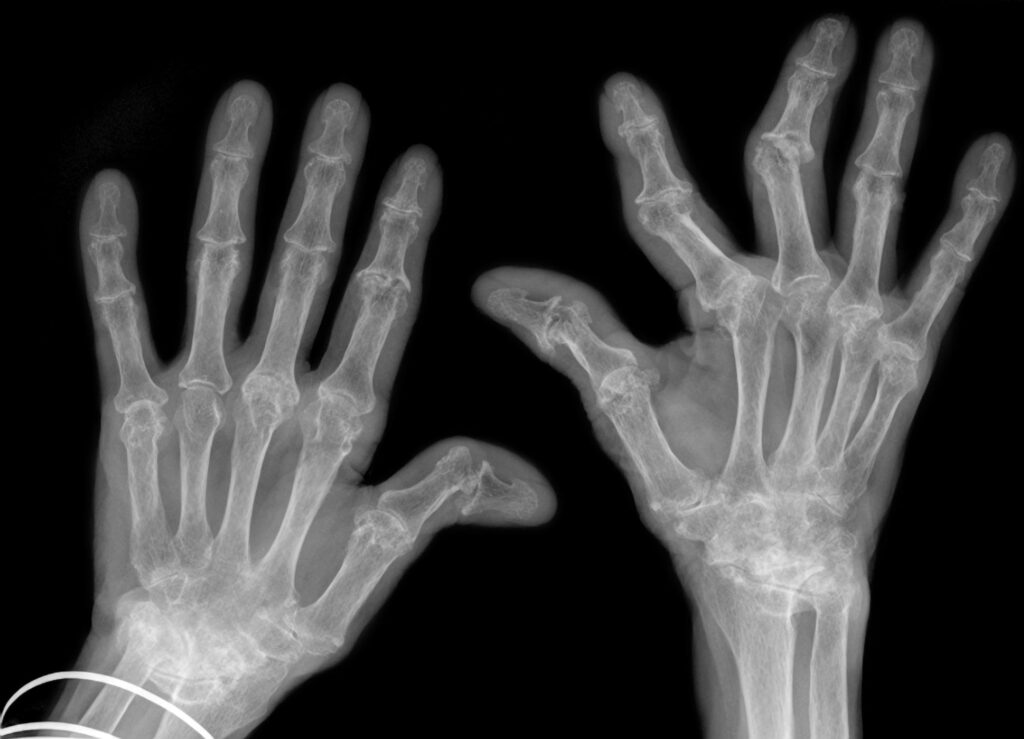 Das Röntgenbild zeigt zwei Hände mit sichtbaren Gelenkverformungen und Knochenerosion, die wahrscheinlich auf eine fortgeschrittene Rheumatoide Arthritis hinweisen.