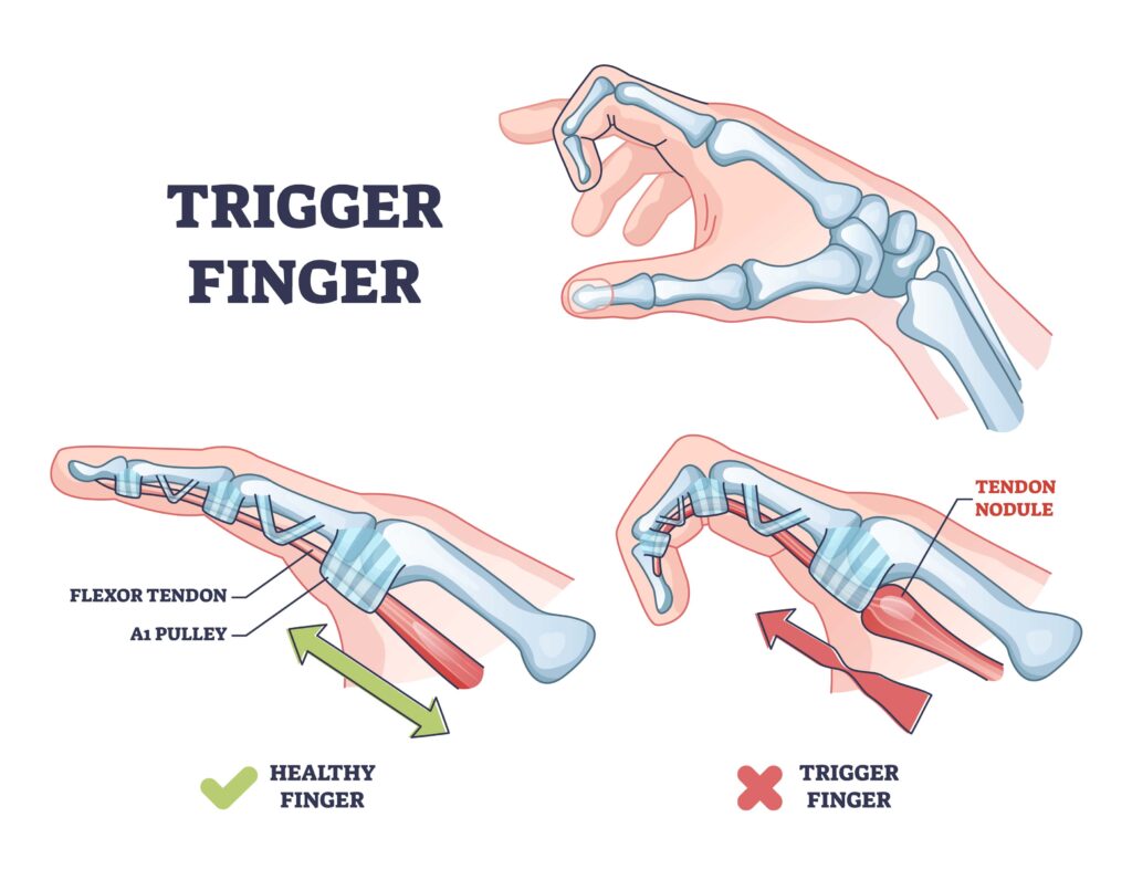 Das Diagramm zeigt den Unterschied zwischen einem gesunden Finger und einem Schnappfinger (Triggerfinger), wobei die Beugesehne, die A1-Riemenscheibe und der Sehnenknoten hervorgehoben werden.