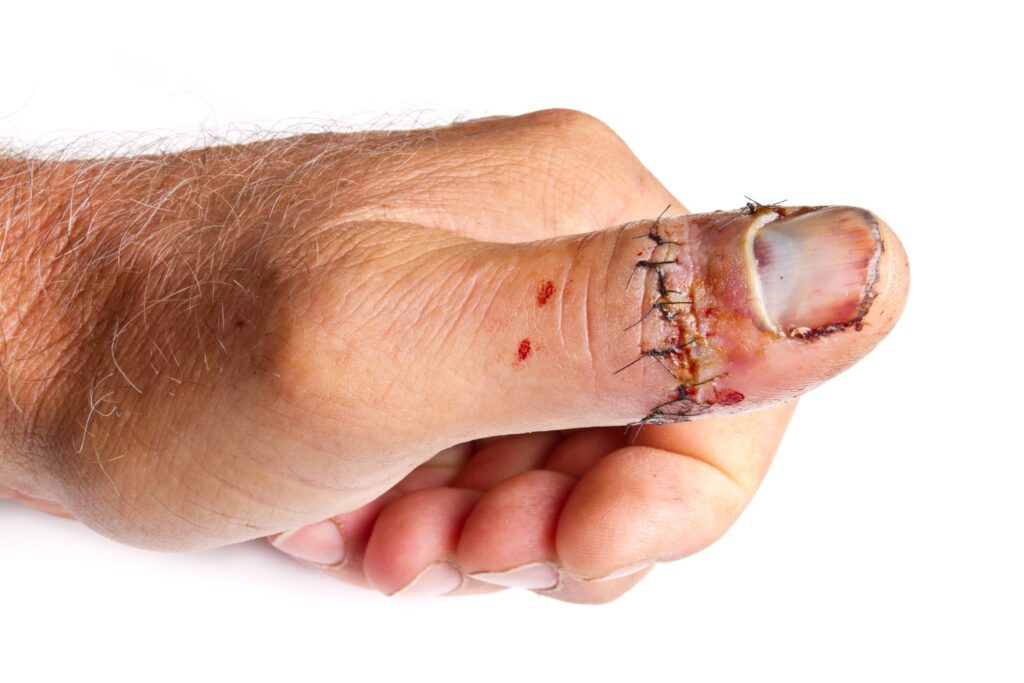 Nahaufnahme eines menschlichen Daumens mit sichtbaren Nähten, Blutergüssen und Schwellungen in der Nähe des Nagels, die auf eine kürzlich durchgeführte Operation oder Schnittverletzungen hinweisen.