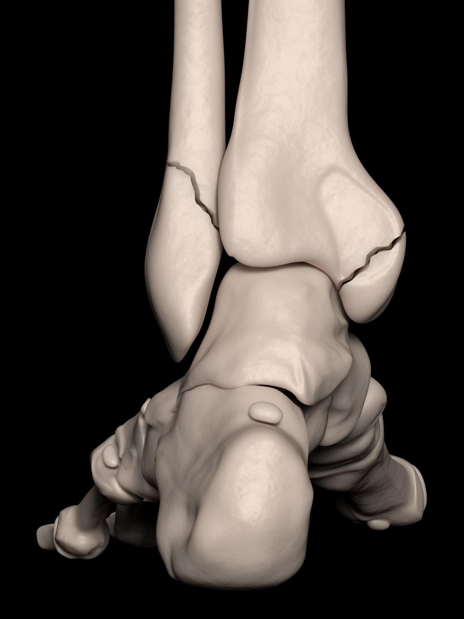Ein 3D-Rendering eines menschlichen Knöchels zeigt sichtbare Frakturen der unteren Schien- und Wadenbeine und illustriert eine Sprunggelenksfraktur vor einem schwarzen Hintergrund.