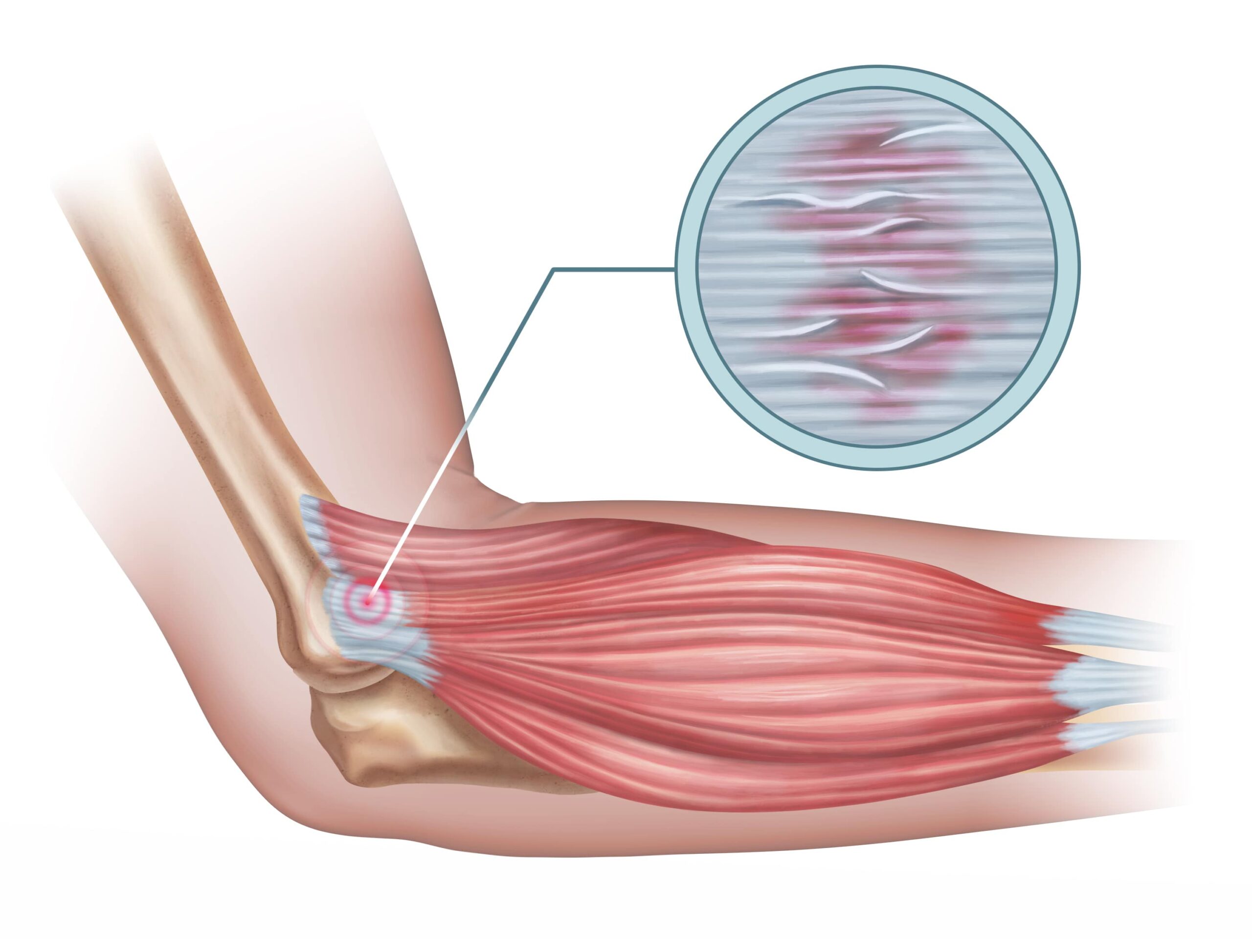 Medizinische Illustration eines Ellenbogens mit Muskelfasern und einer vergrößerten Ansicht, die die für den Tennisarm oder Golferarm typischen Gewebeschäden an der Stelle, an der der Muskel am Knochen ansetzt, hervorhebt.