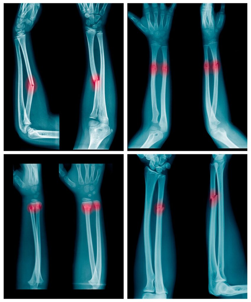 Röntgenbilder von Unterarmen und Handgelenken mit rot hervorgehobenen Bereichen in der Nähe der Handgelenke weisen auf mögliche Knochenbrüche oder Verletzungen hin, insbesondere an der Speiche und den angrenzenden Hand- oder Fingerknochen.