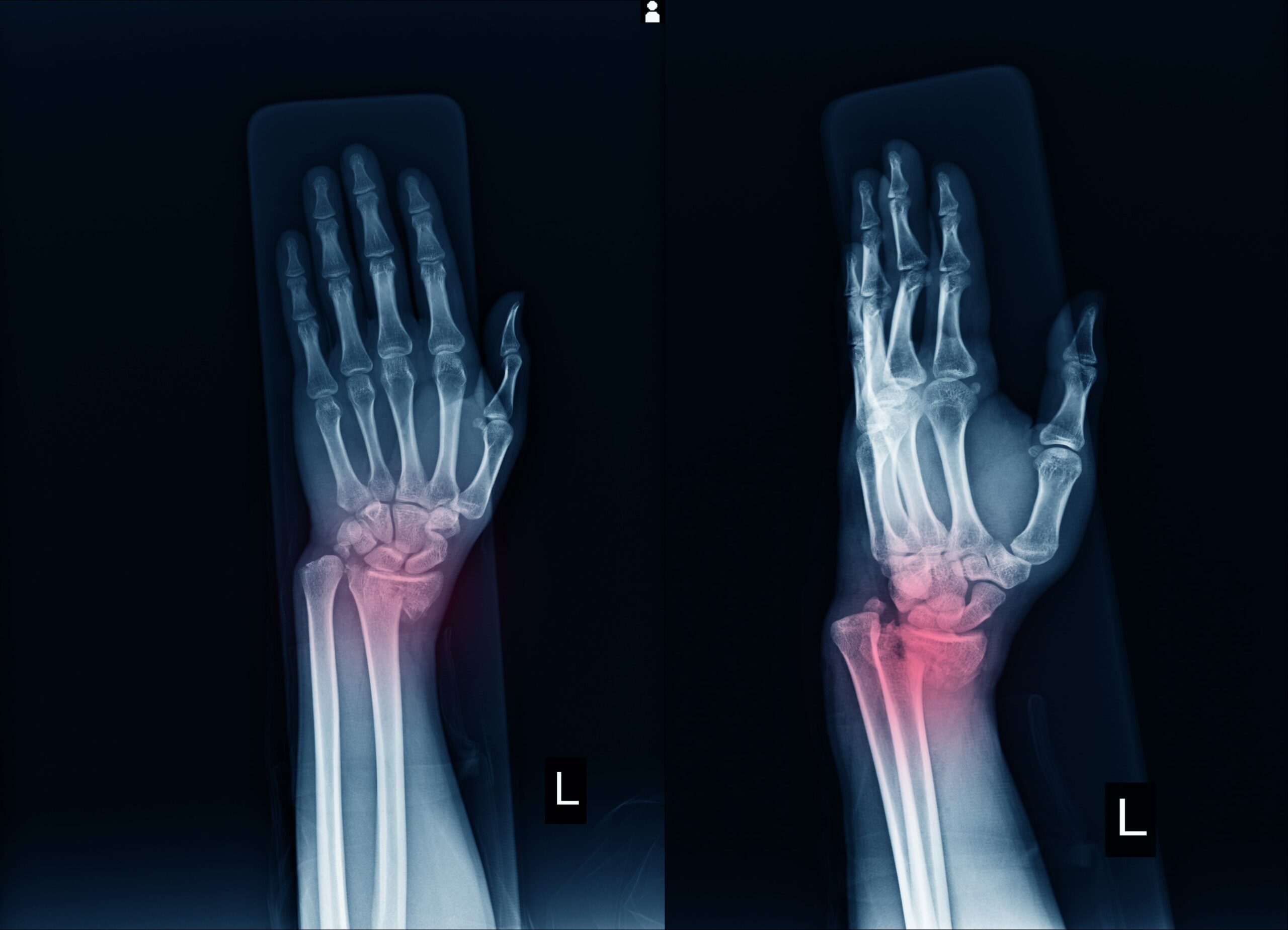 Röntgenbilder einer linken Hand und eines linken Handgelenks aus zwei Winkeln, wobei der Bereich des Handgelenks hervorgehoben wird - möglicherweise ein Hinweis auf eine distale Radiusfraktur oder eine andere Anomalie.