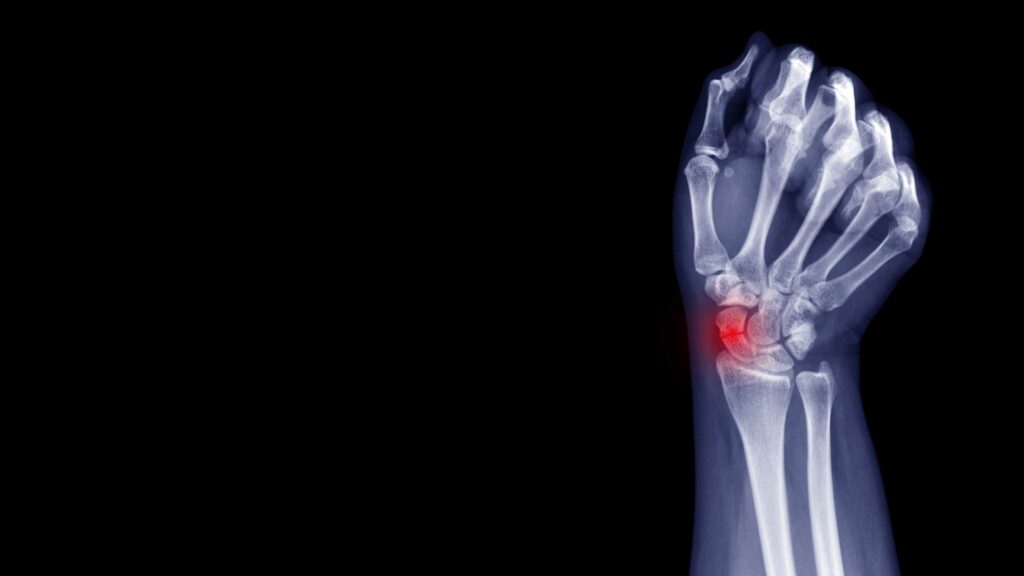 Röntgenbild einer menschlichen Hand und eines Handgelenks mit einem rot hervorgehobenen Bereich, der auf einen möglichen Kahnbeinbruch oder eine andere Anomalie im Handgelenk hinweist.