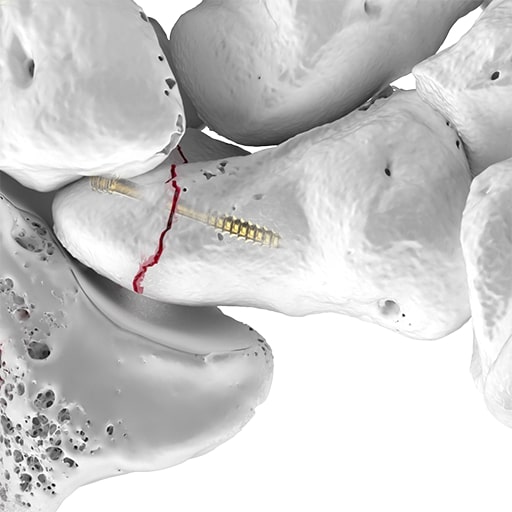 3D-gerendertes Bild der Fußknochen mit einem Kahnbeinbruch (Scaphoidfraktur), der mit zwei Schrauben entlang einer roten Frakturlinie fixiert wurde.