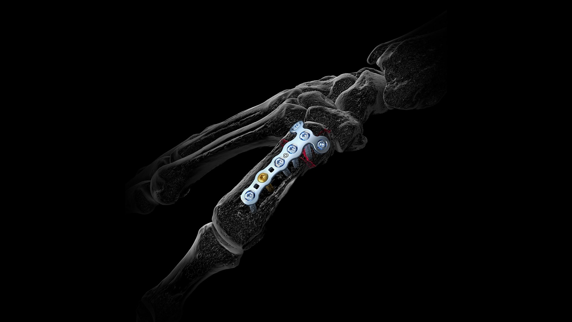 Die Röntgenaufnahme einer Hand zeigt eine orthopädische Metallplatte mit Schrauben, die an einer Mittelhandknochenfraktur befestigt ist und den gebrochenen Fingerknochen stabilisiert.