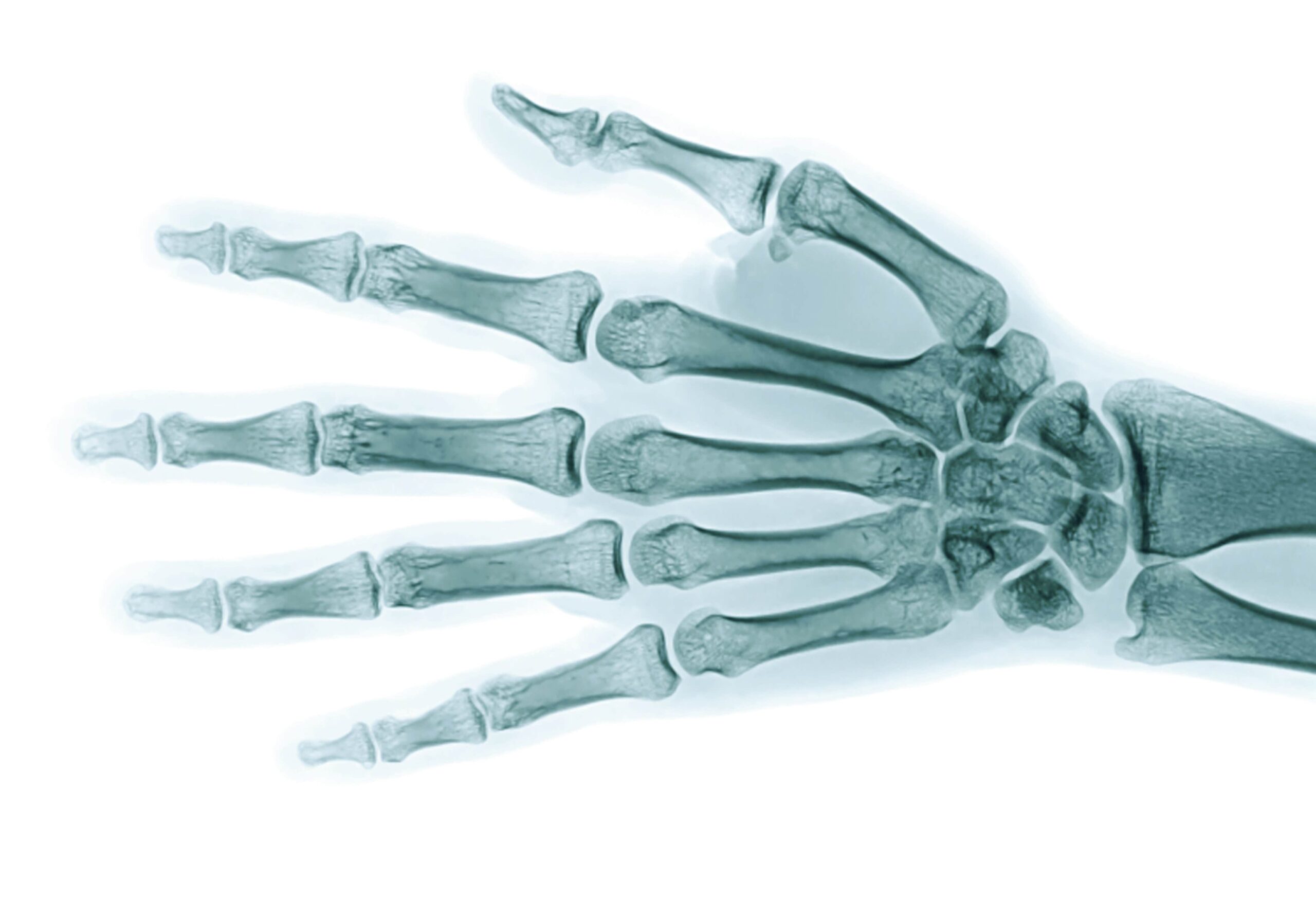 Röntgenbild einer menschlichen linken Hand, das Knochen, Gelenke und die Ausrichtung von Fingern und Handgelenk zeigt - ideal für die Diagnostik in der Orthopädie Innsbruck.