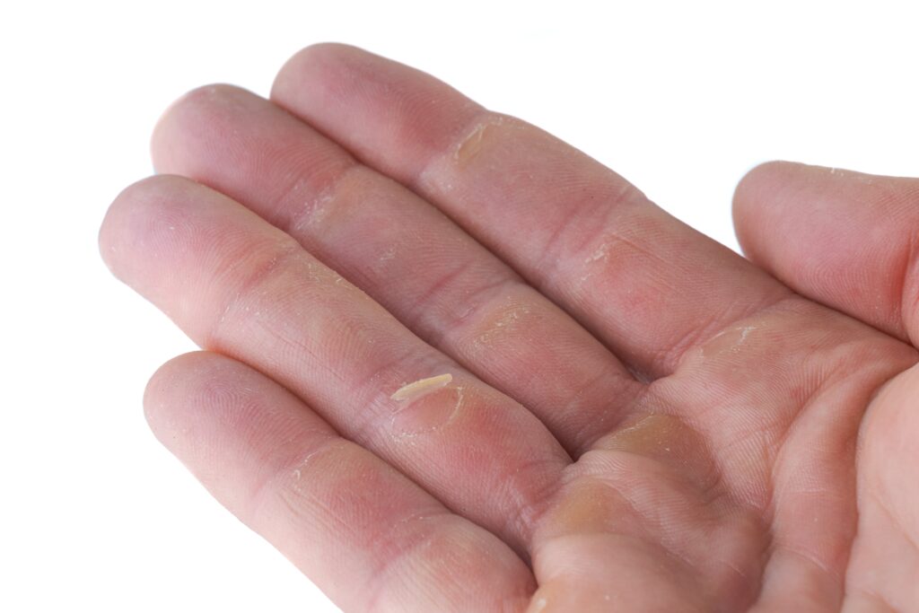 Eine Nahaufnahme der Hand einer Person mit einem kleinen Holzsplitter in der Handfläche, der auf häufige Kletterverletzungen wie Hautverletzungen und das Risiko eines A2-Ringbandrisses hinweist.