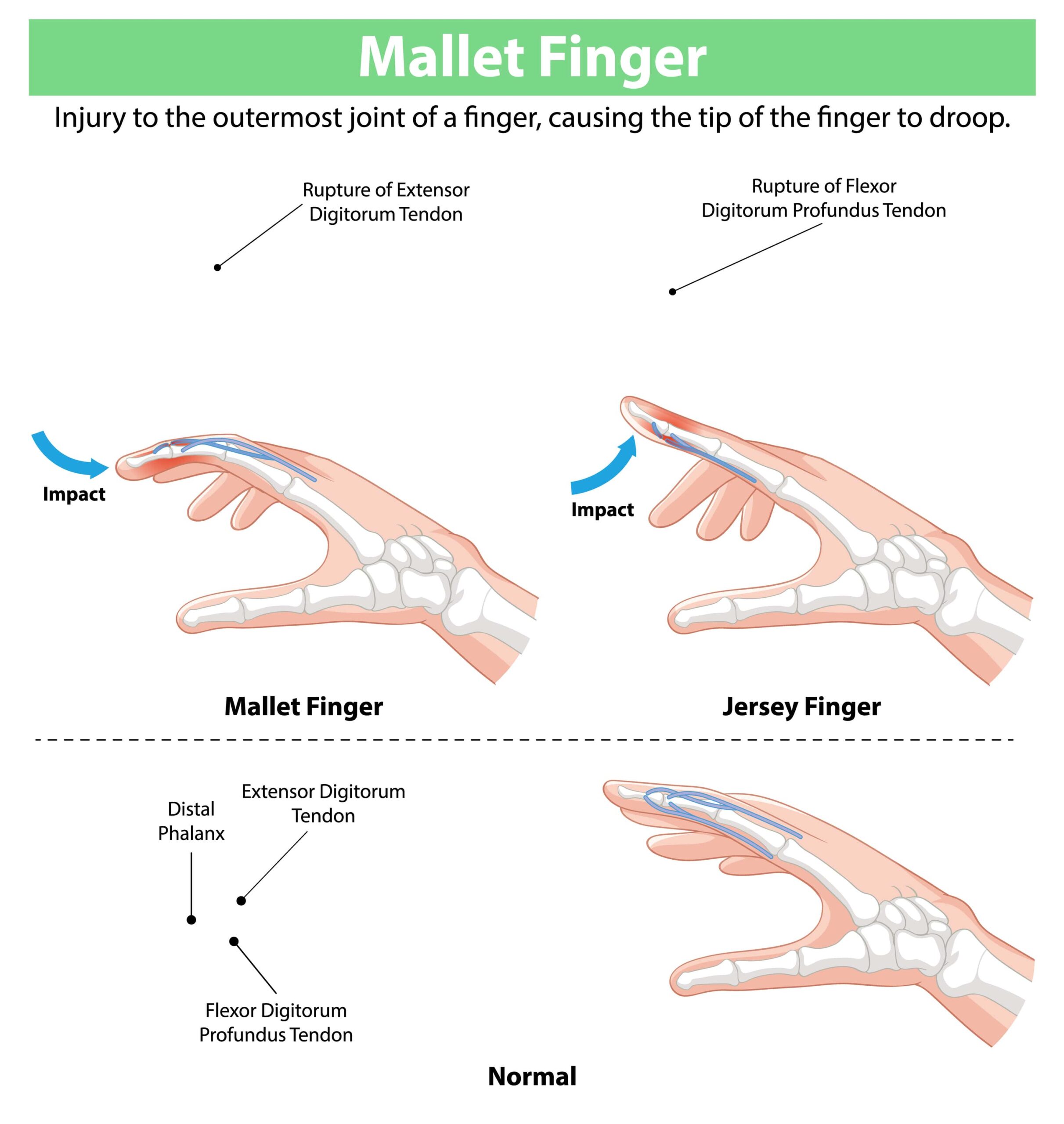 Medizinische Illustration zum Vergleich von Mallet-Finger und Strecksehnenausriss (Knöchern), die Sehnenrisse und einen normalen Finger zeigt. Die betroffenen Sehnen und Gelenke sind zur besseren Orientierung beschriftet.