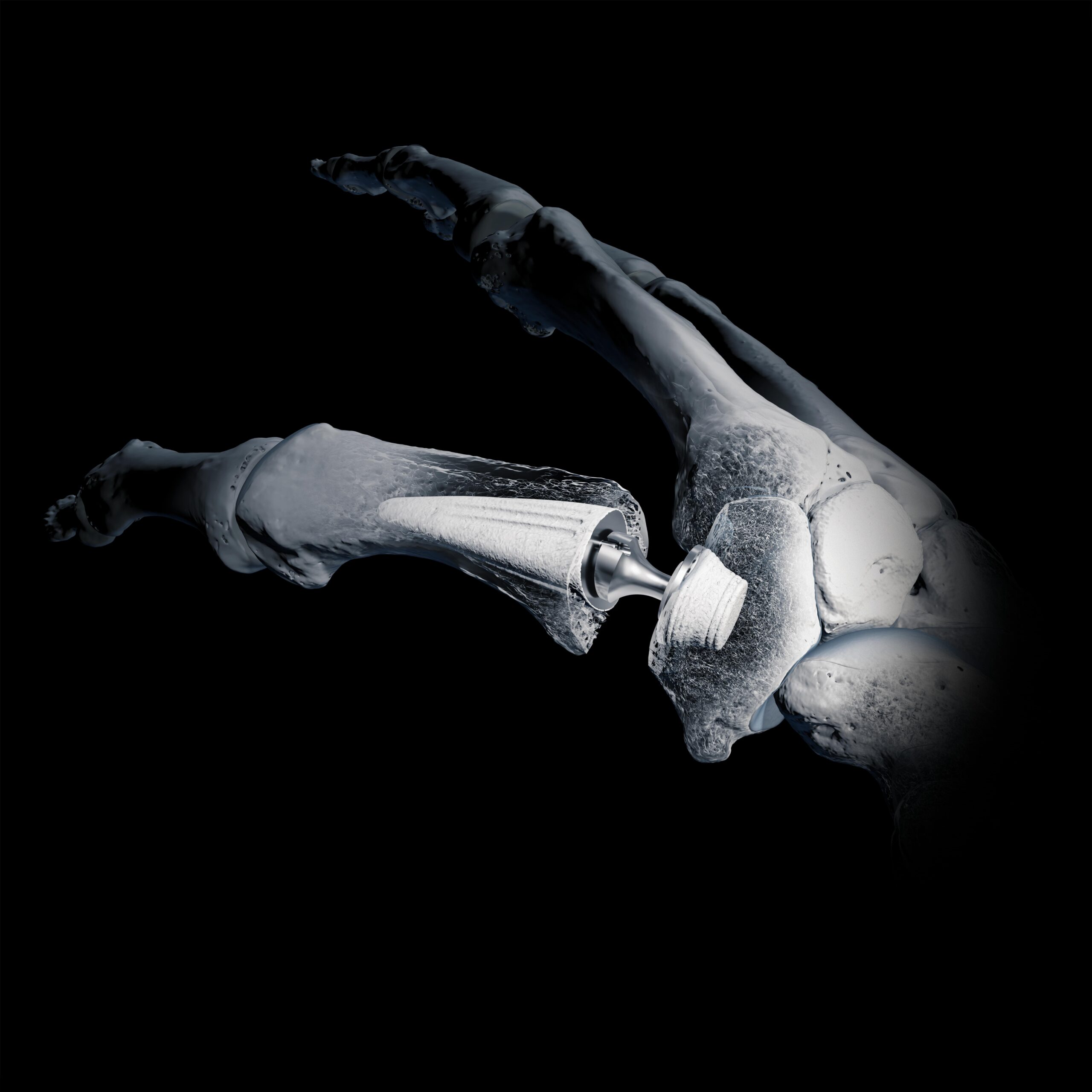 Röntgenbild eines menschlichen Beins mit einem Kniegelenkimplantat aus Metall, das die Kniegelenkersatzoperation verdeutlicht und an Fortschritte wie die Daumensattelgelenksprothese erinnert.