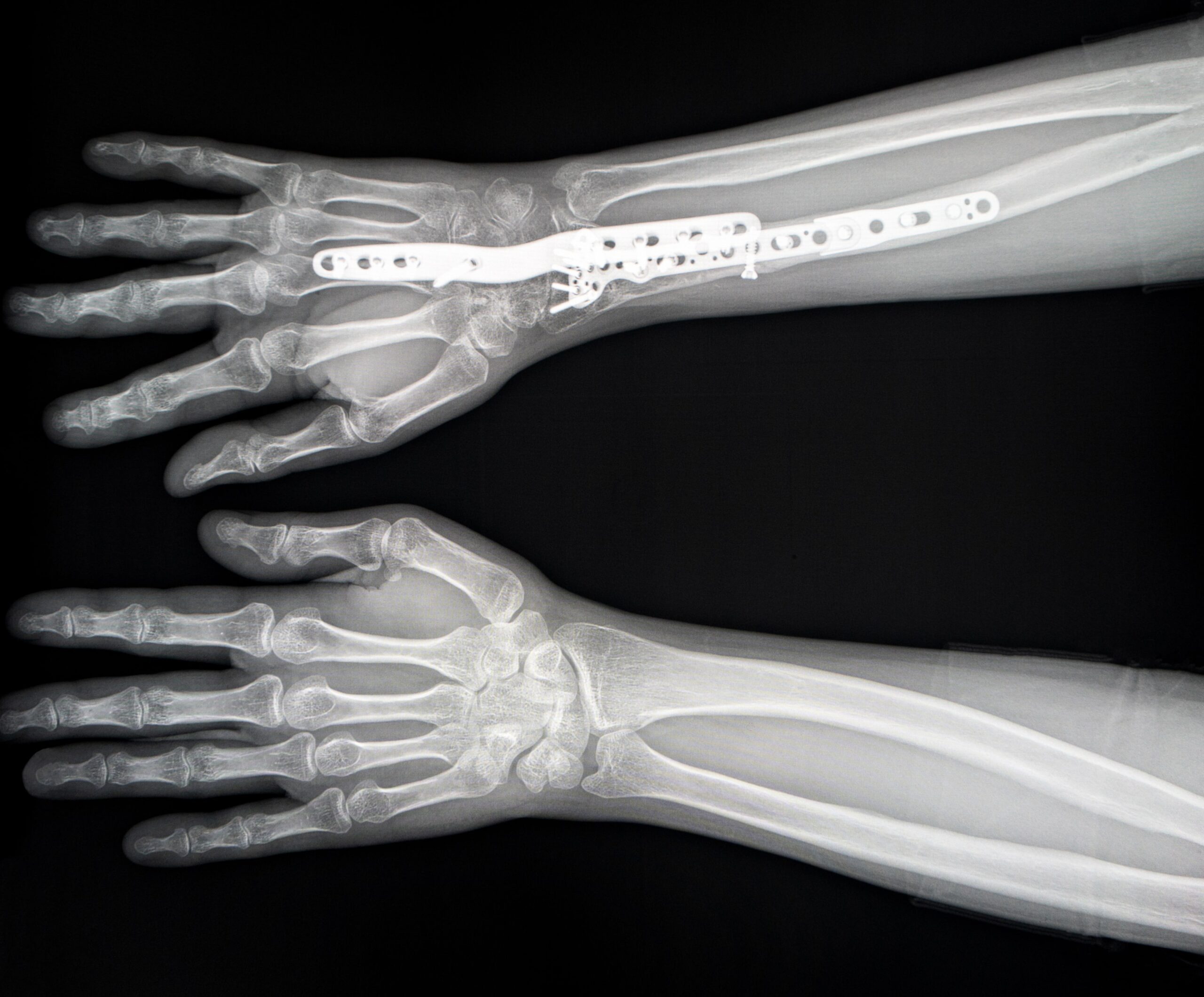Röntgenbild, das zwei Unterarme zeigt; der obere Unterarm ist mit einer chirurgischen Metallplatte und Schrauben am Radiusknochen befestigt, möglicherweise zur Behandlung einer Handgelenksarthrose, während der untere Unterarm ohne Implantate normal erscheint.