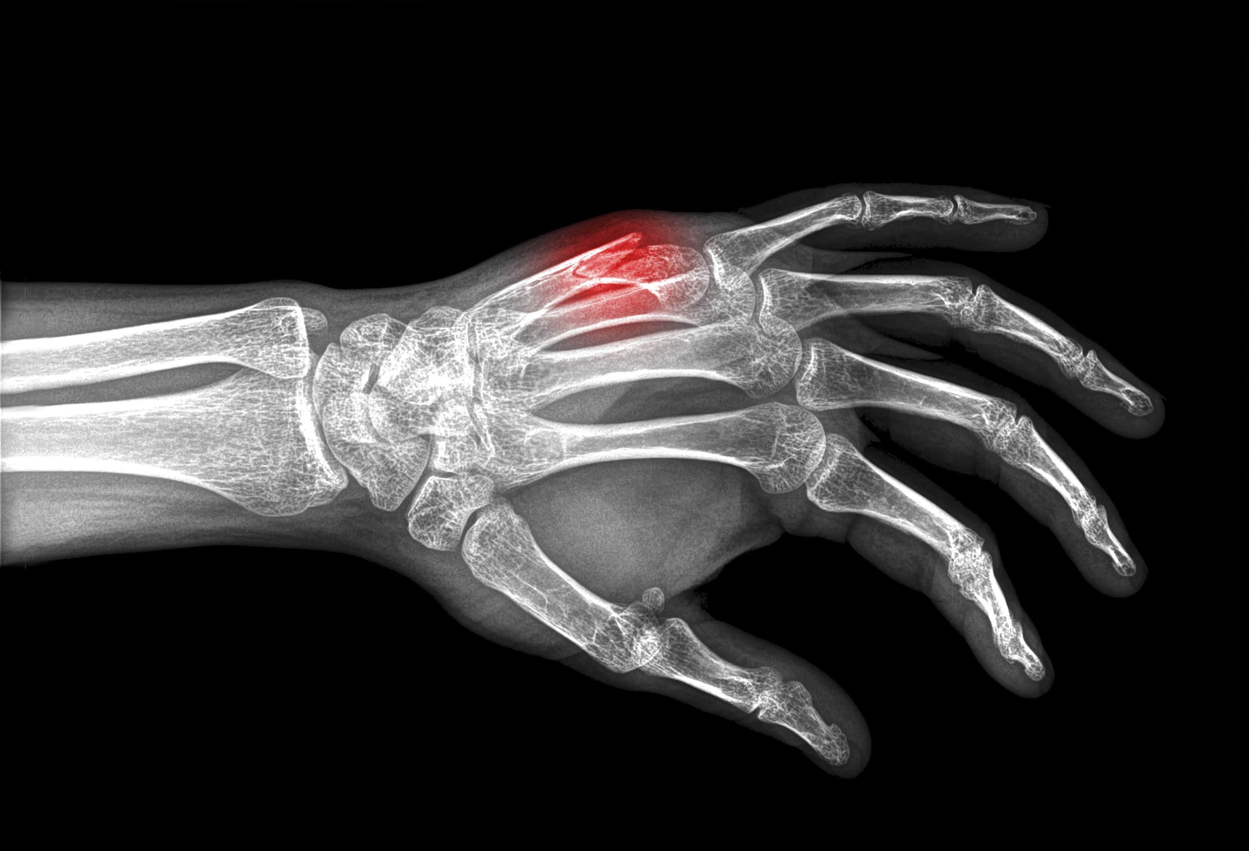 Röntgenbild einer menschlichen Hand, das die Knochen zeigt, mit einem hervorgehobenen roten Bereich in der Nähe der Daumenwurzel, der auf eine mögliche Mittelhandknochenfraktur oder -verletzung hinweist.