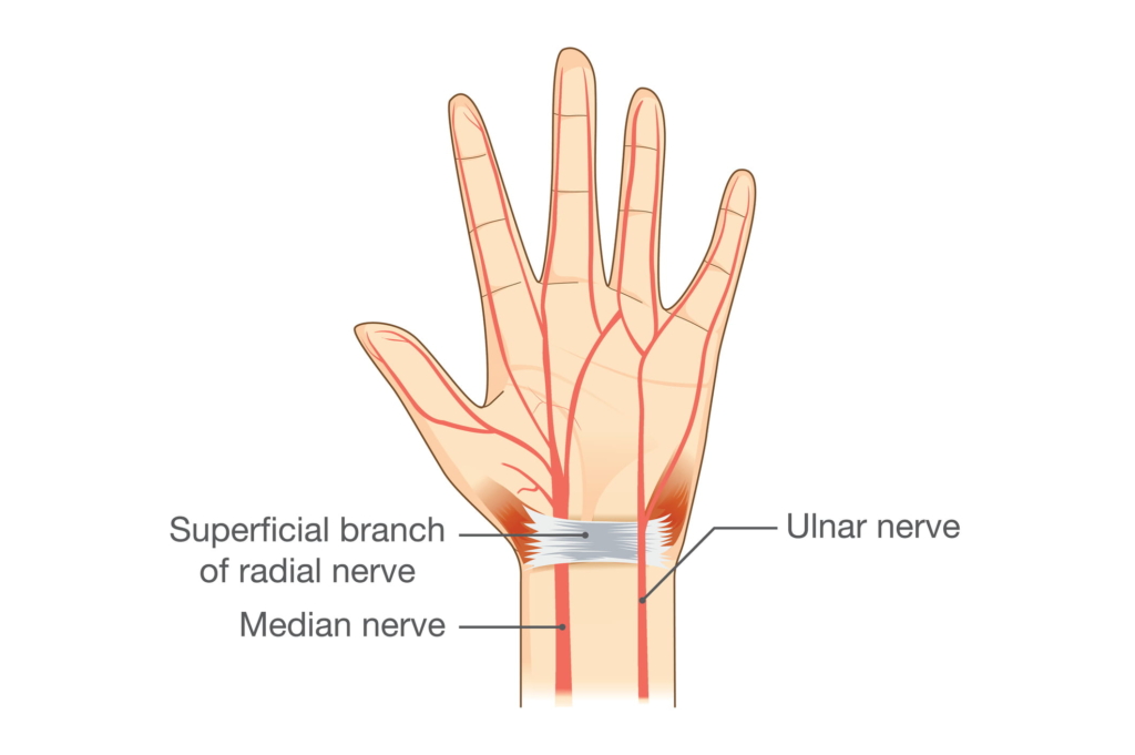 Die Abbildung einer Hand zeigt die oberflächlichen Äste des Nervus radialis, des Nervus medianus und des Nervus ulnaris in der Nähe des Handgelenks, wobei die beim Guyon-Loge-Syndrom häufig betroffenen Bereiche hervorgehoben werden.