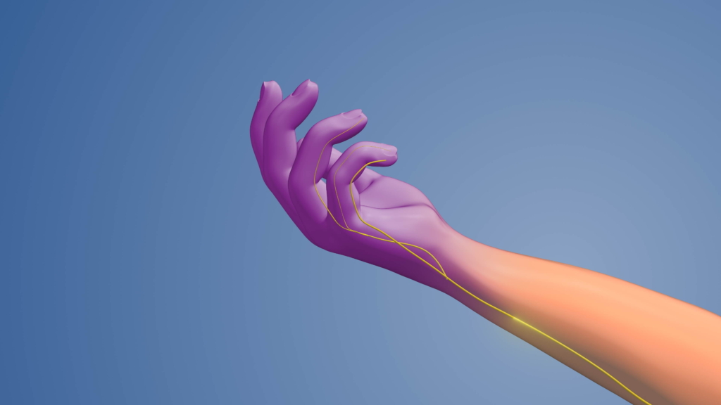 Guyonsche-Loge-Symptom Eine stilisierte Illustration einer menschlichen Hand und eines Unterarms, bei der die Haut lila und orange gefärbt ist, hebt eine gelbe Nervenlinie hervor - Merkmale, die mit dem Guyon-Loge-Syndrom in Verbindung gebracht werden.