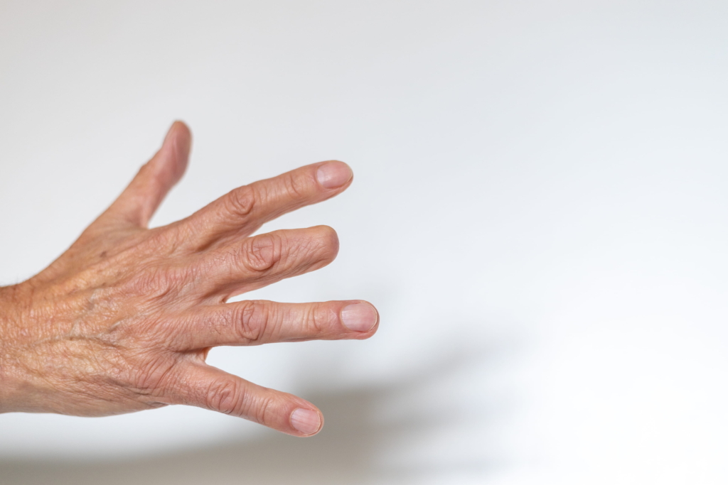 Lokale-Lappenplastiken Eine ausgestreckte Hand mit sichtbaren Falten und Adern wird vor einem schlichten weißen Hintergrund gezeigt, der einen schwachen Schatten wirft - ideal für die Darstellung von Techniken wie Lokale Lappenplastiken.