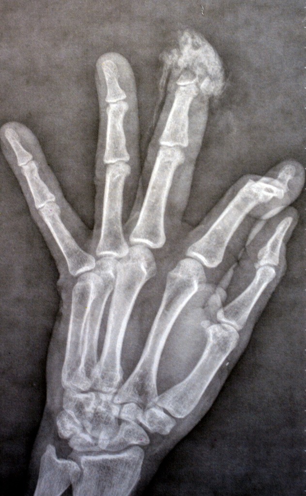 Röntgenbild einer linken Hand mit erheblichem Knochenverlust und Deformierung des Zeigefingers, was auf eine fortgeschrittene Gelenkerkrankung oder ein mögliches Trauma hindeutet; Lokale Lappenplastiken können für eine rekonstruktive Behandlung in Betracht gezogen werden.