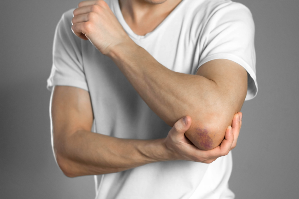 Person in einem weißen T-Shirt, die ihren wunden rechten Ellbogen hält, der geprellt und verfärbt erscheint - mögliche Anzeichen einer Radiuskopffraktur - vor einem einfarbigen grauen Hintergrund.