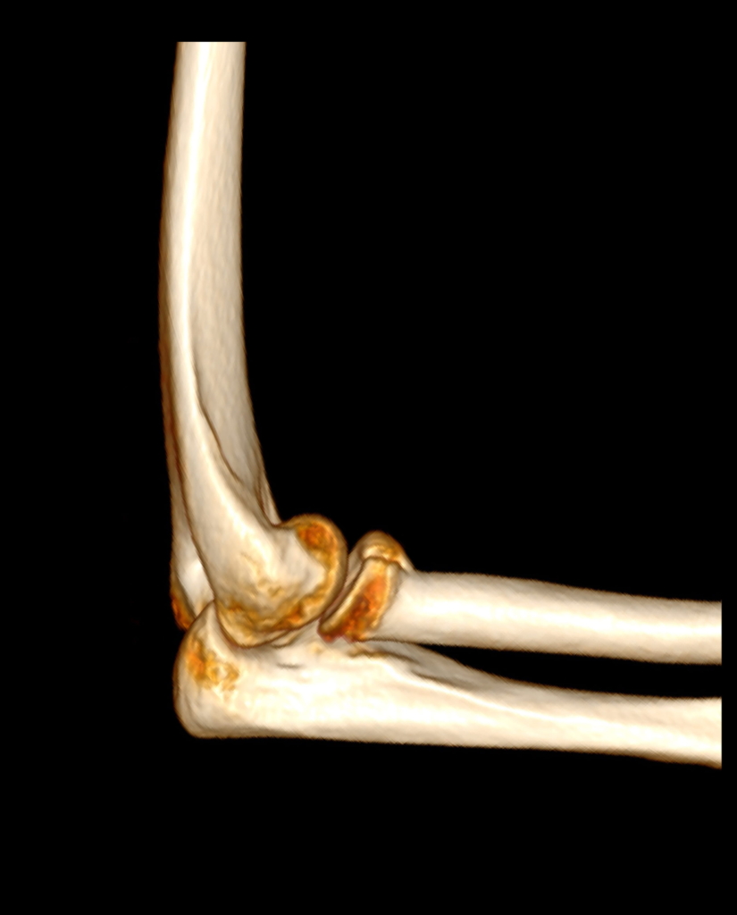 3D-Darstellung eines menschlichen Ellenbogengelenks mit Oberarmknochen, Speiche und Elle vor einem schwarzen Hintergrund - ideal für das Studium der Anatomie der Radiuskopffrakturen.