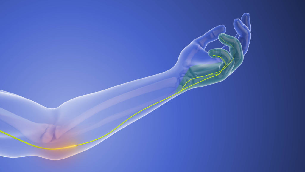 Sulcus Nervus Ulnaris Symptom Illustration eines menschlichen Arms mit hervorgehobenen Nerven, die vom Ellbogen bis zur Hand verlaufen, wobei die Nervenbahnen in gelber Farbe auf blauem Hintergrund dargestellt sind - eine informative Darstellung des Sulcus Nervi Ulnaris Syndroms.