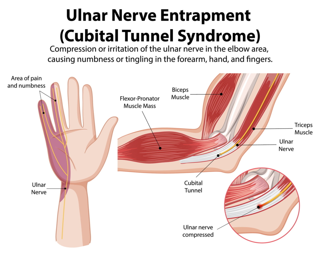 Diagramm zur Darstellung der Einklemmung des Nervus ulnaris am Ellenbogen beim Sulcus Nervi Ulnaris Syndrom, wobei die betroffenen Bereiche der Hand hervorgehoben und die relevanten Muskeln und die Nervenkompression beschriftet sind.