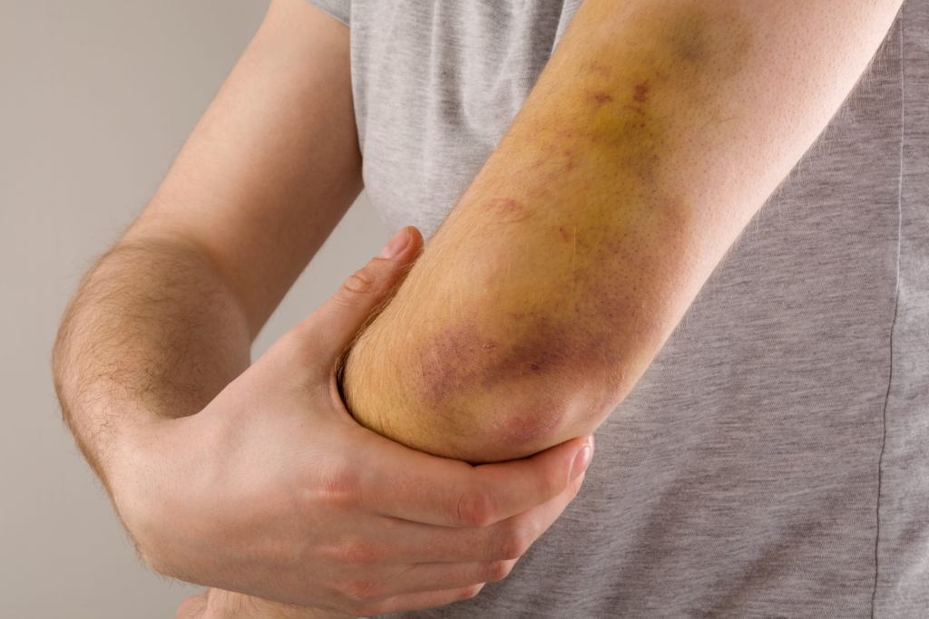 Triceps Eine Person in einem grauen Hemd hält sich den Ellenbogen, der sichtlich geprellt und mit gelben und violetten Flecken verfärbt ist - Anzeichen, die auf eine Grunderkrankung wie Enchondrom hindeuten könnten.