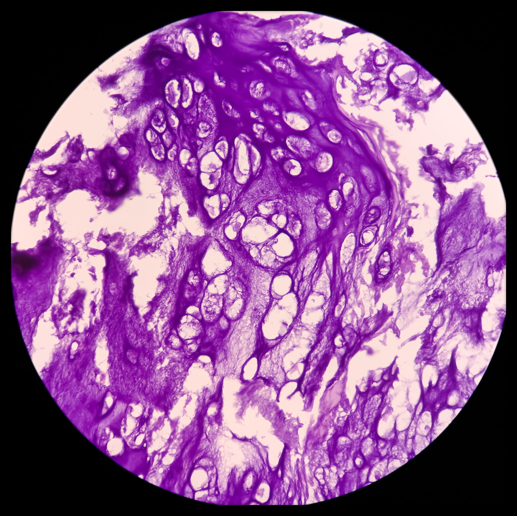 Mikroskopische Ansicht einer mit violettem Farbstoff gefärbten Gewebeprobe, die unter Vergrößerung Drüsenstrukturen, Bindegewebe und Merkmale zeigt, die auf ein Enchondrom hindeuten.