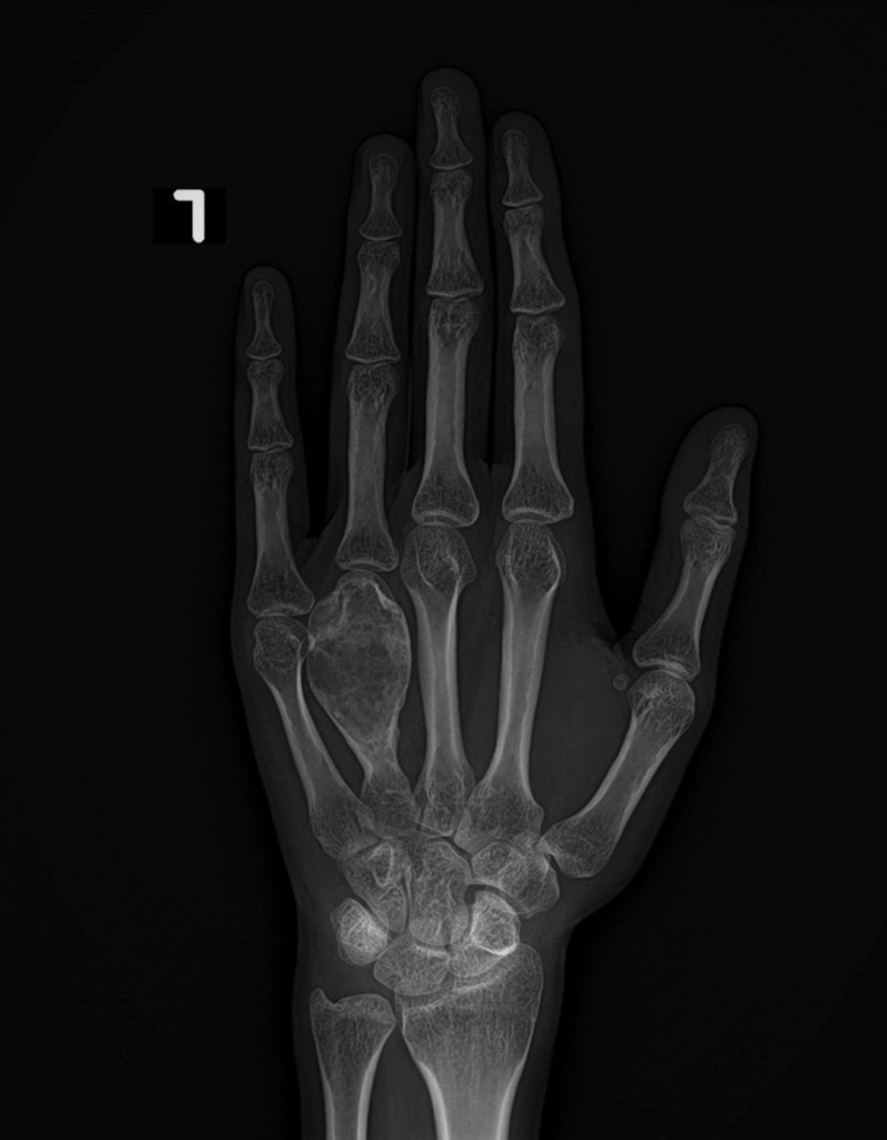 enchondrom Röntgenbild einer linken Hand, auf dem die Knochen zu sehen sind. Alle Finger sind ausgestreckt und mit der Nummer 1 in der oberen linken Ecke gekennzeichnet; möglicherweise ist ein Enchondrom in einem der Fingerglieder zu sehen.