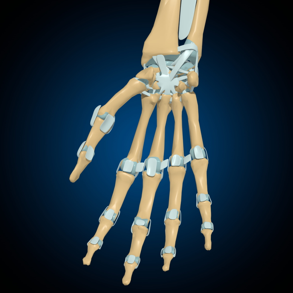 Illustration eines menschlichen Handskeletts mit Metallimplantaten, die an verschiedenen Finger- und Handgelenken befestigt sind und die Behandlung der Seitenbandruptur der Finger verdeutlichen, dargestellt vor einem dunkelblauen Hintergrund mit Farbverlauf.